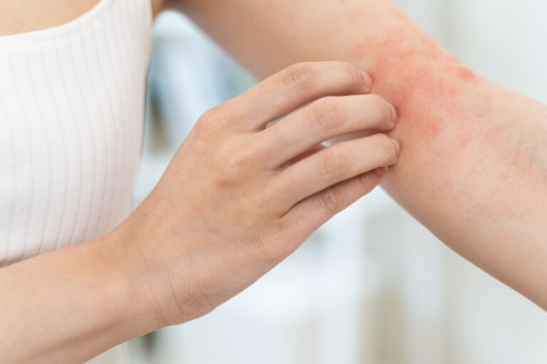 Dermatiti allergiche: segnali di pulizia?