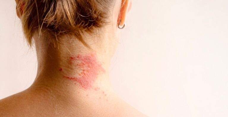 Dermatite atopica: cos’è e come riconoscerla