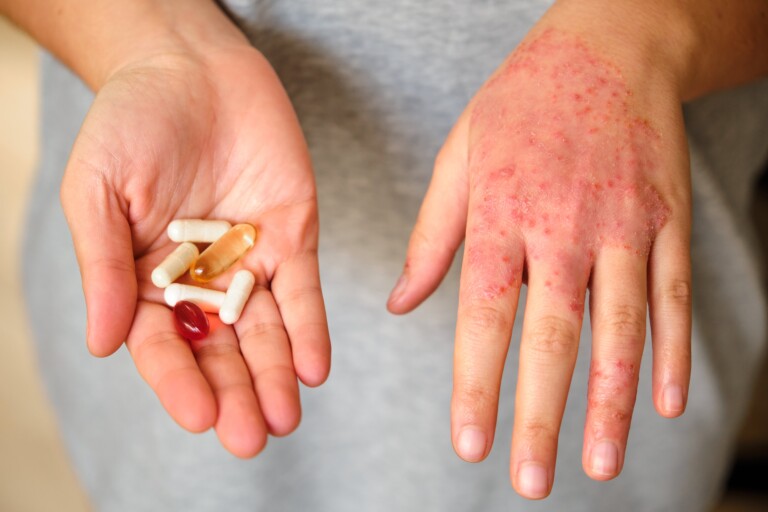Dermatite: quando la pelle brucia